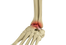 Ankle Arthritis