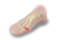 Hallux Rigidus - Big Toe Arthritis