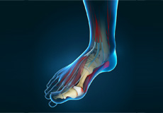 Bunions - Hallux Valgus