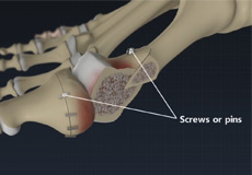 Bunions - Hallux Valgus